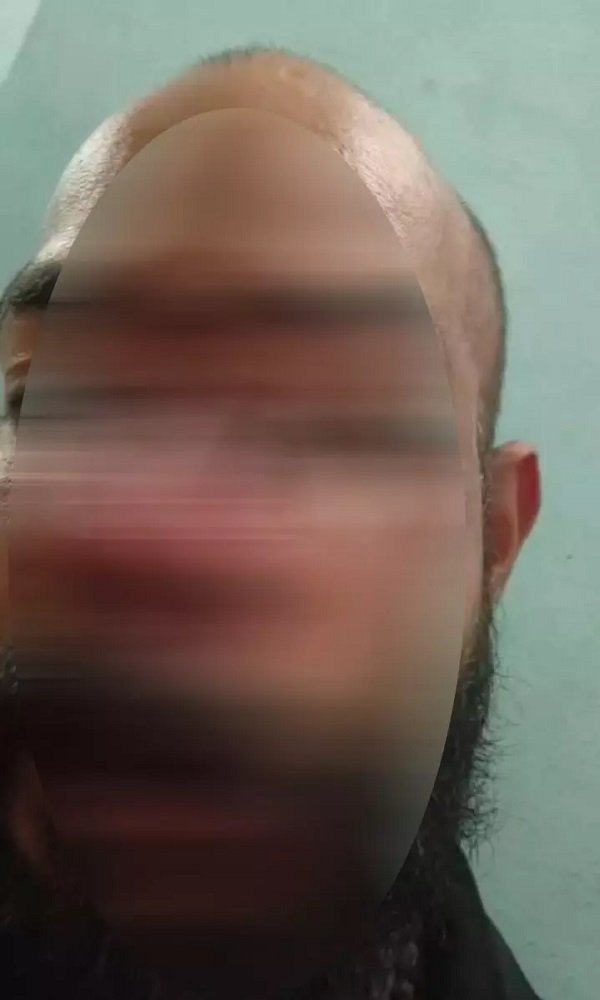 CG CRIME : दुर्ग-भिलाई के बदमाशों ने बार में मचाया उत्पात, पिस्टल के बट्टे से कारोबारी का चेहरा कुचला