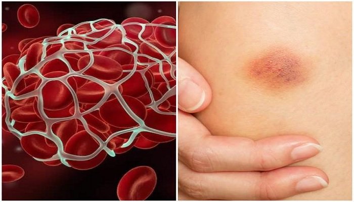 Blood Clot Warning Signs: शरीर में ब्लड क्लॉट बनने से पहले नजर आ सकते हैं ये संकेत, इन्हें न करें नजरअंदाज
