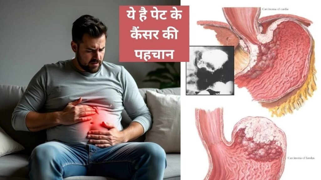 पेट के कैंसर का पहला संकेत क्या है? इन 6 लक्षणों को लोग अक्सर गैस-अपच समझकर कर देते हैं नजरअंदाज